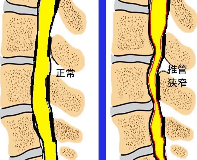腰椎管狭窄压迫腿神经腿疼怎么办?
椎管狭窄压迫腿部神经引起的疼痛啊，有三种治疗方