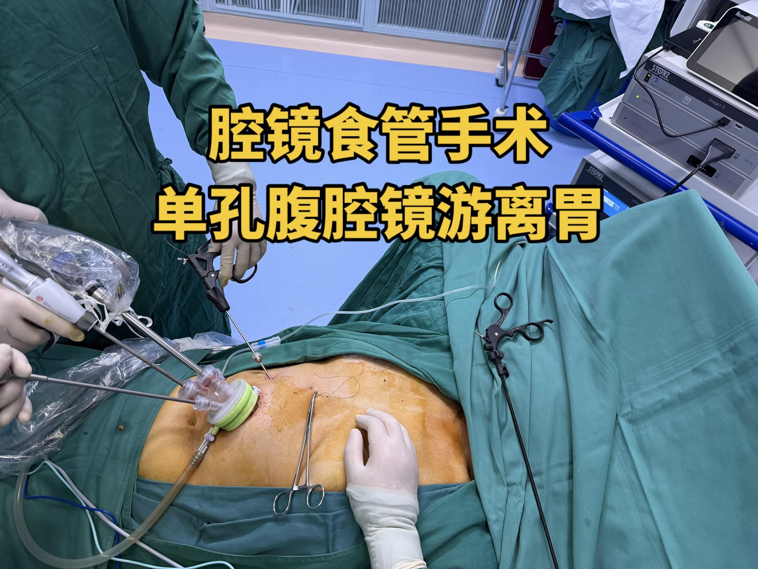 超微创微孔食管癌手术。把手术做到极致，单孔腹腔游离胃部分