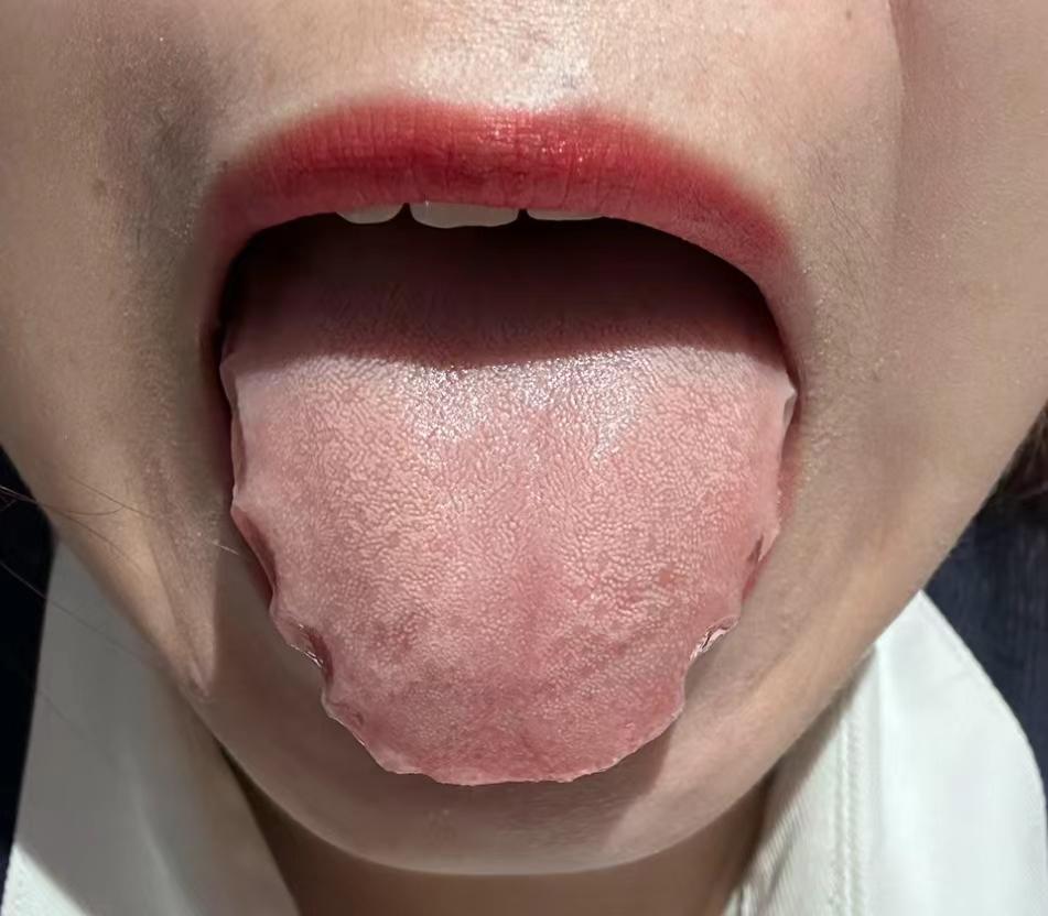 凡是这种舌头，说你脾虚湿气重的，那医术实在是太差了[发怒]
为什么潘医生会这样说
