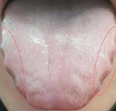 舌胖大齿痕 + 水滑舌，肚子胀总不好？这是阳气快 “熄火” 了，中焦没火力才胀！