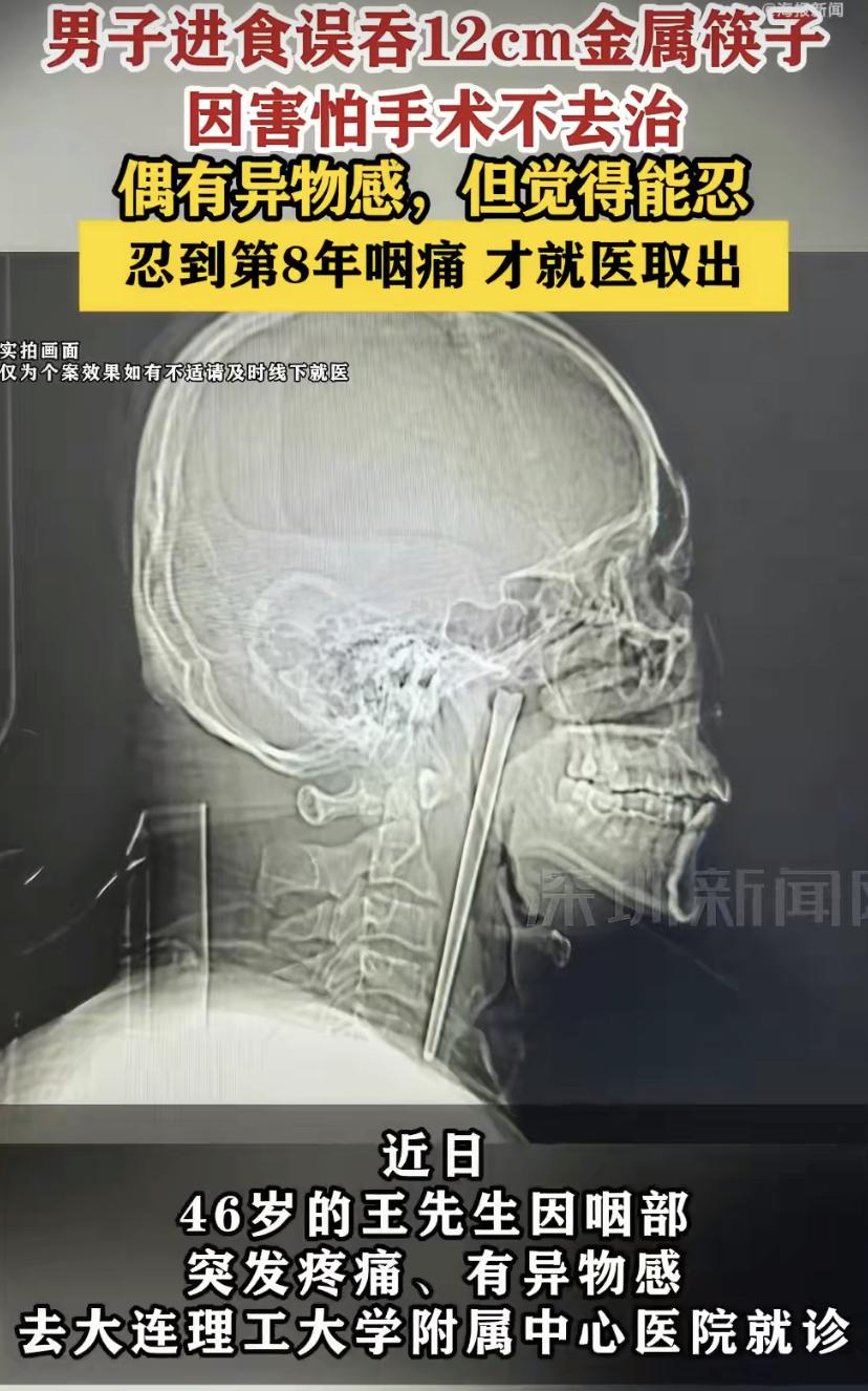 辽宁大连这位46岁的大哥，真是让人捏把汗!8年前吃饭时不小心吞了根12厘米长的金