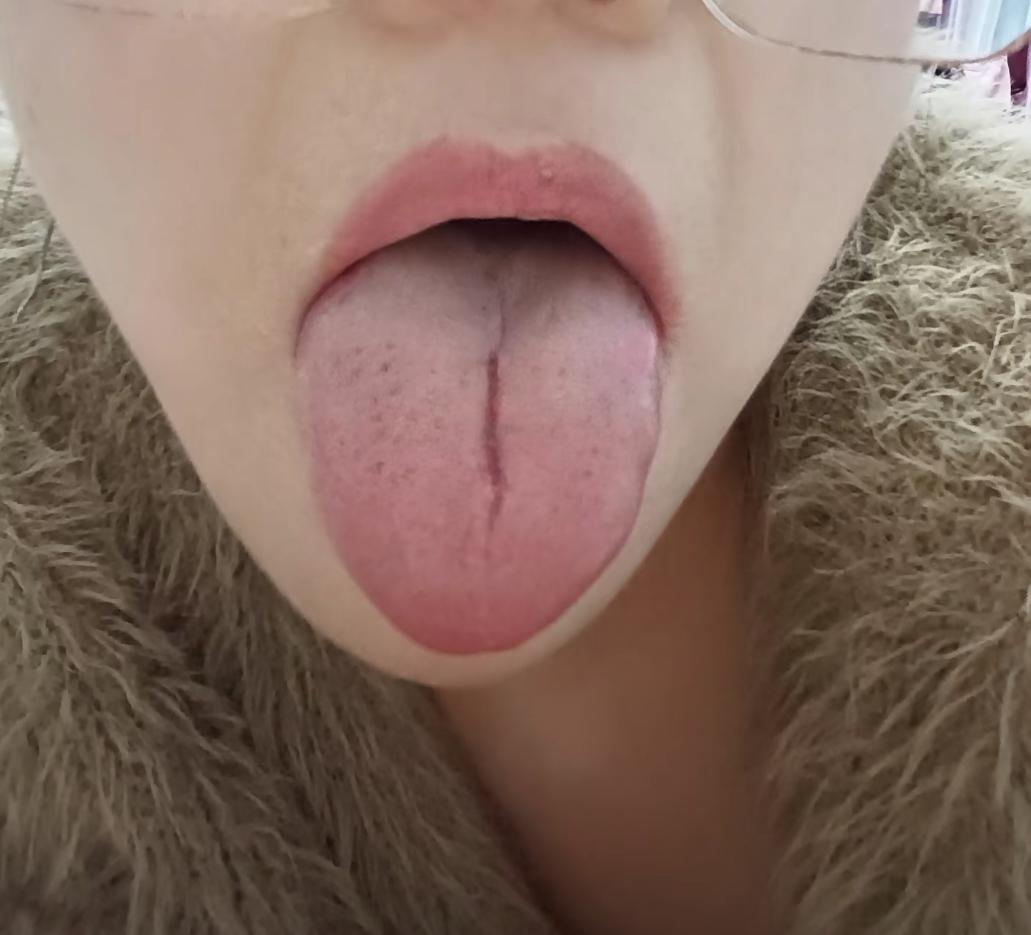 舌中裂纹不可怕，你要更注意小红点了[恐惧]
脾胃虚弱是人人都懂的病，今天这个舌象
