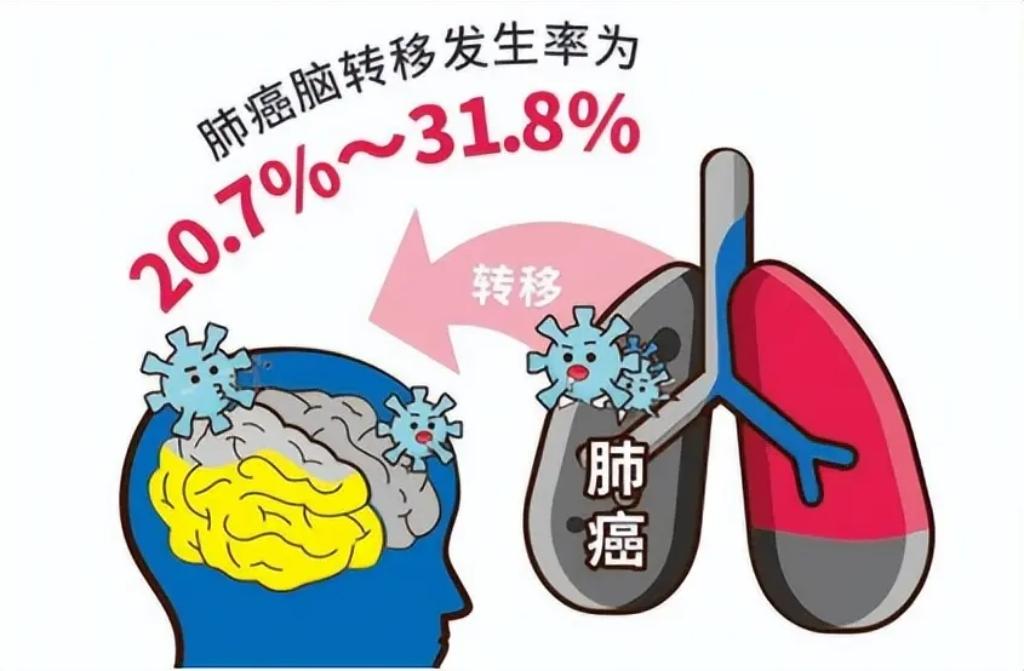 肺癌诊疗已步入“精准时代”。通过基因检测明确驱动基因突变，为患者“量体裁衣”制定