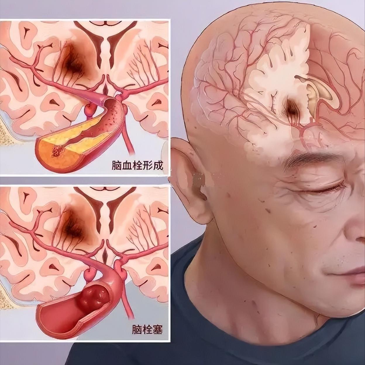 脑梗是怎么来的？这三个祸根，很多人天天都在做

脑梗不是突然掉下来的，而是日积月