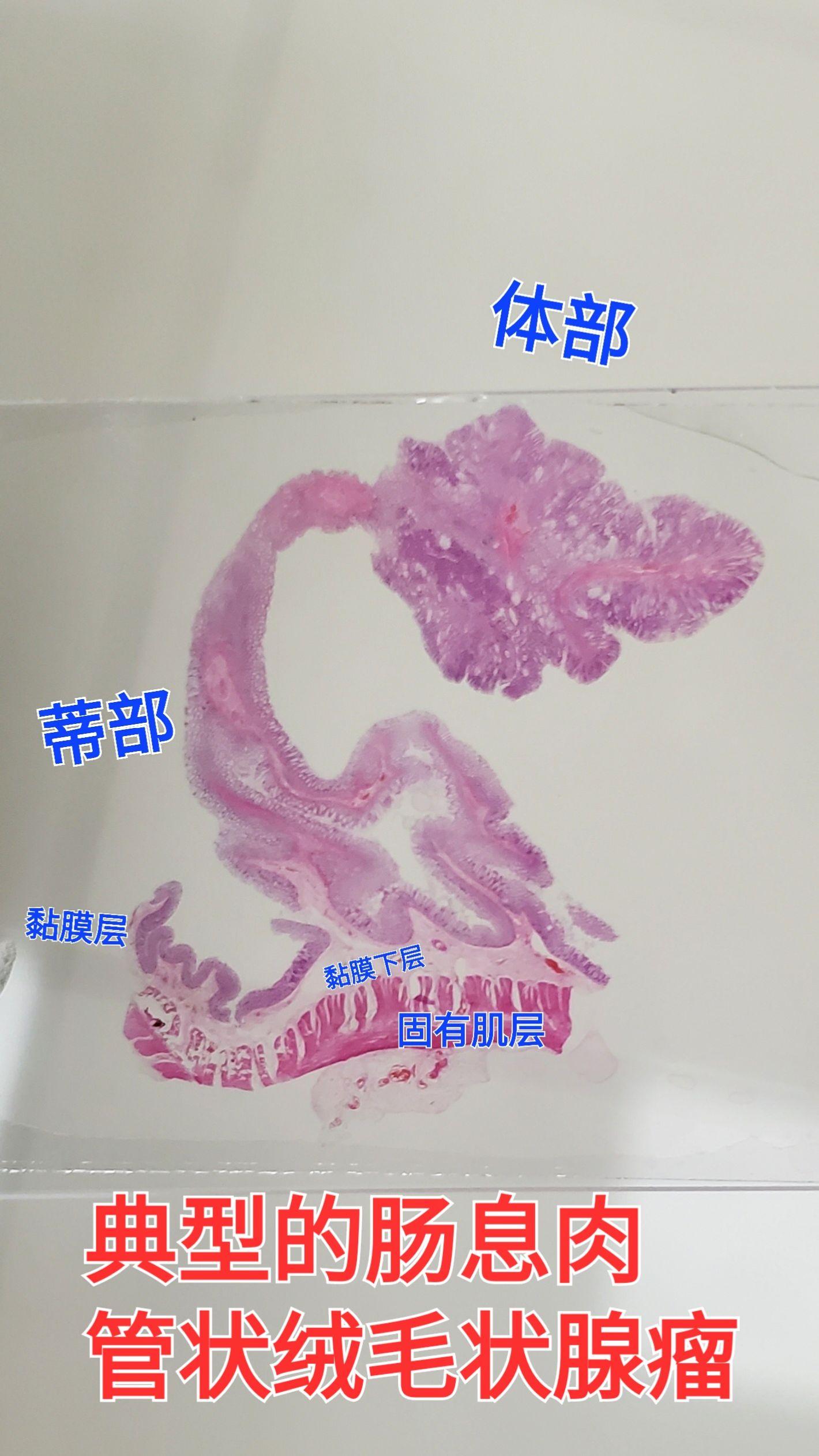 管状绒毛状腺瘤