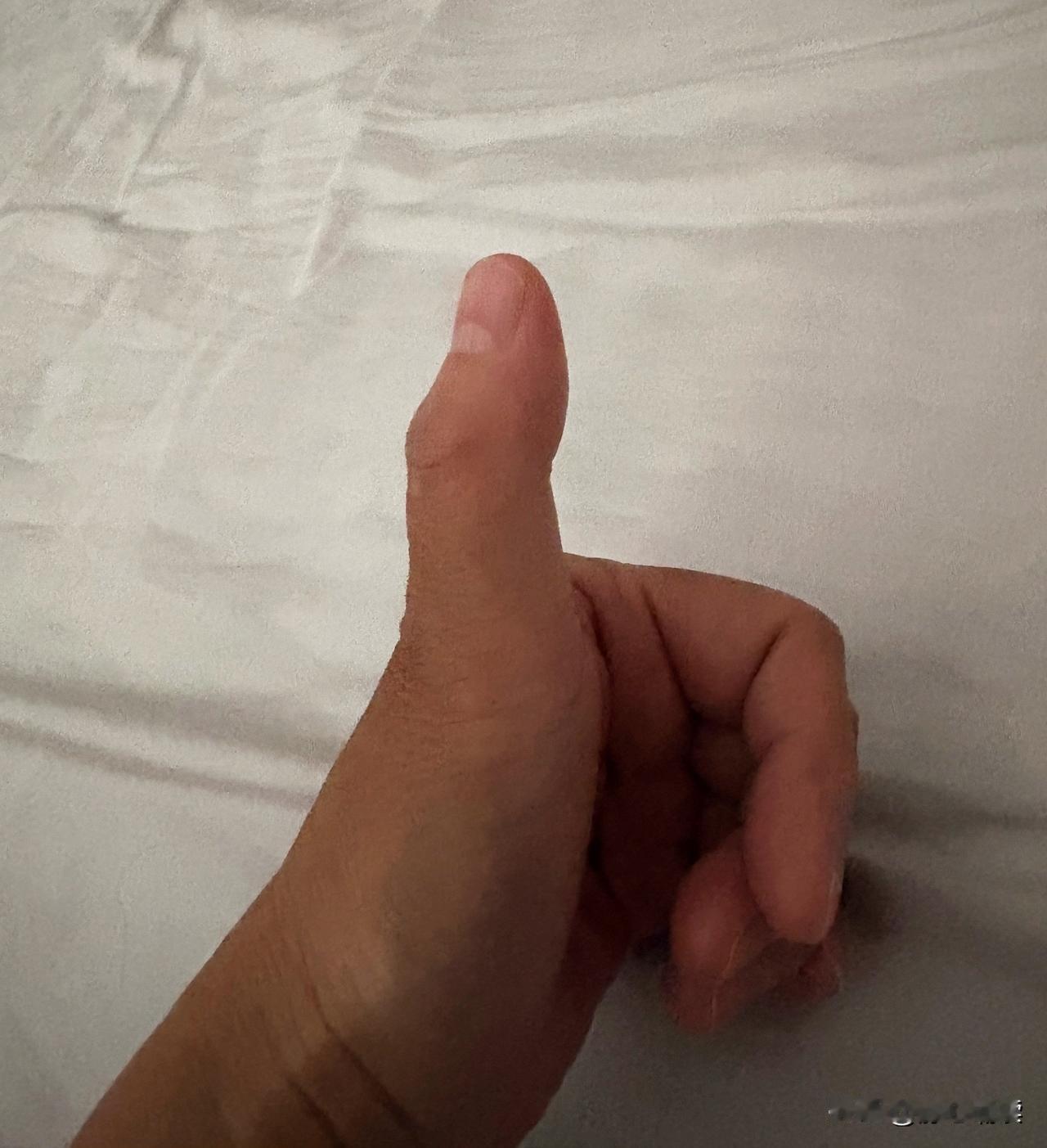 去年十二月初，我的左手大拇指开始不舒服，一检查发现是腱鞘炎。
腱鞘炎看似是个小毛