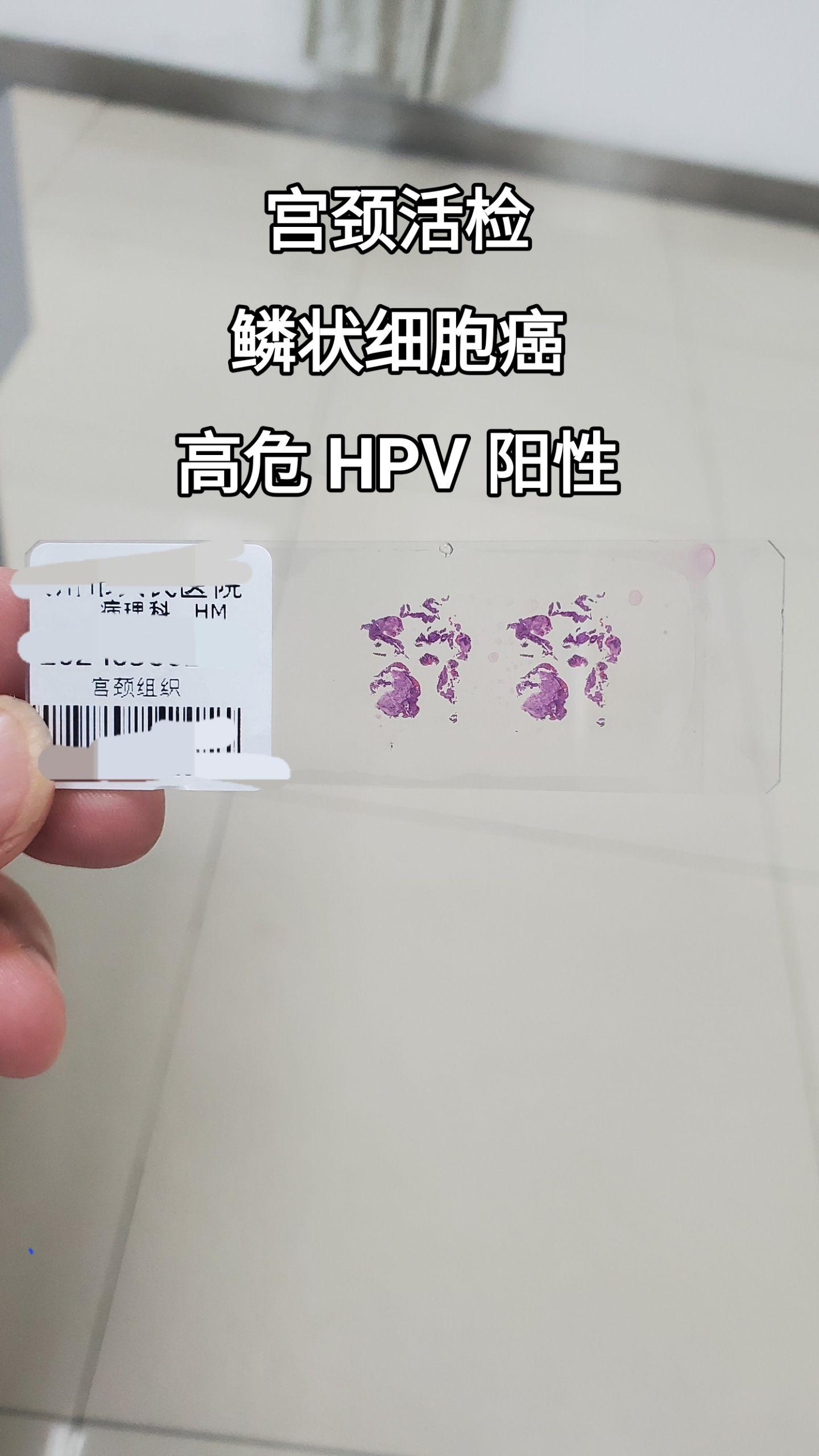 宫颈癌