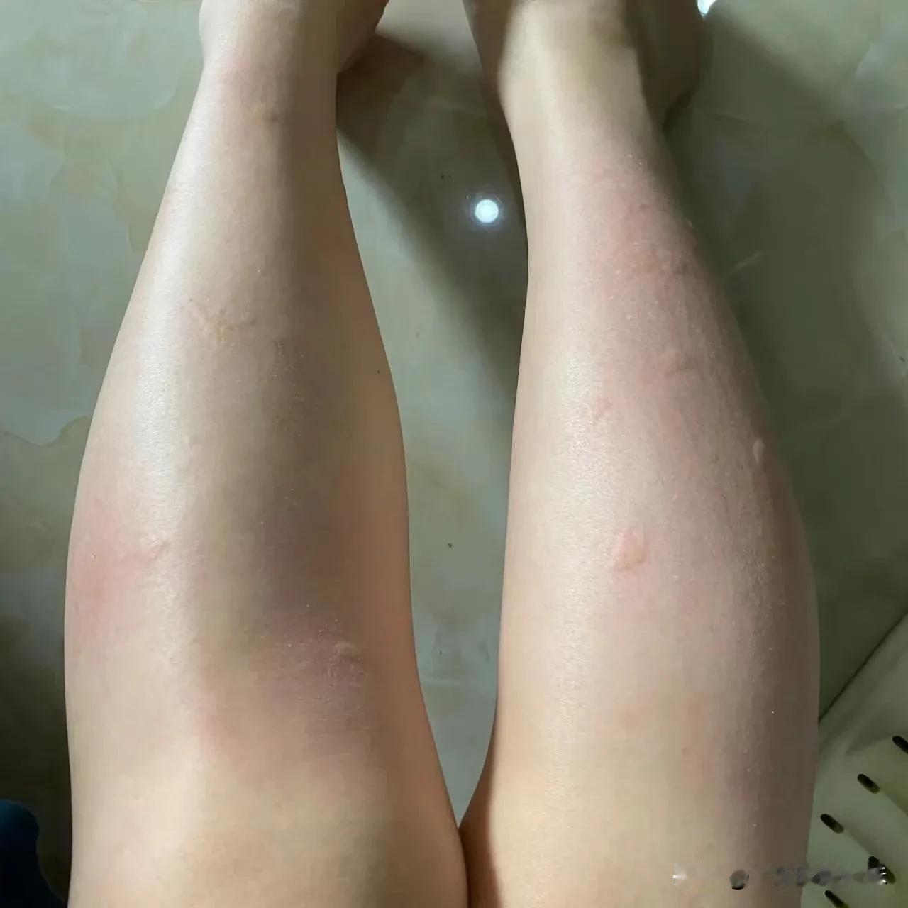 都到秋天了，天气慢慢转凉了，为什么还有那么多小蚊子，那小蚊子，你不留意都看不见，