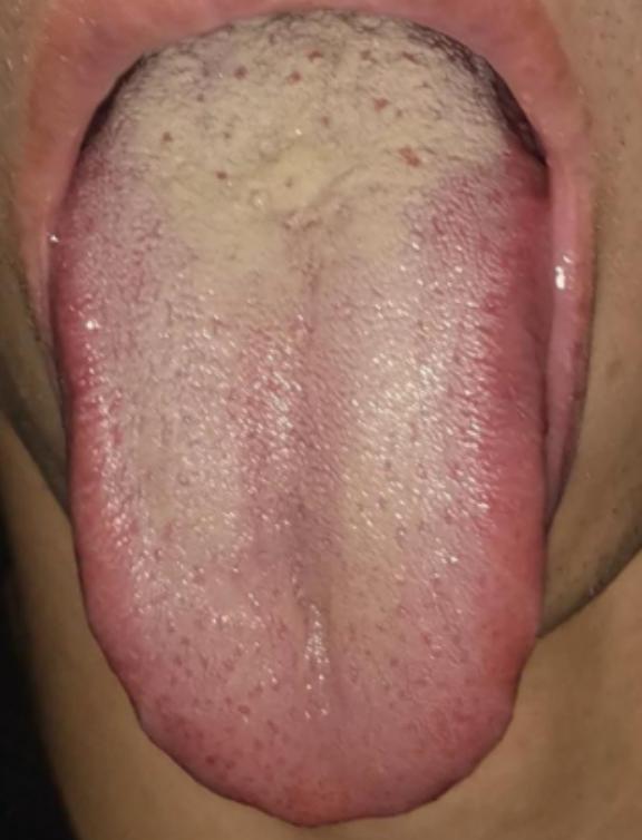 舌头都这样了，你还敢去吃六味地黄芄，这不是在拿身体开玩笑！
 
像这个舌头，舌根