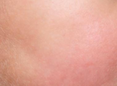 好烦啊！我身边姐妹们下面都长了毛发，就我是光溜溜的，感觉自己像个另类
 
【患者