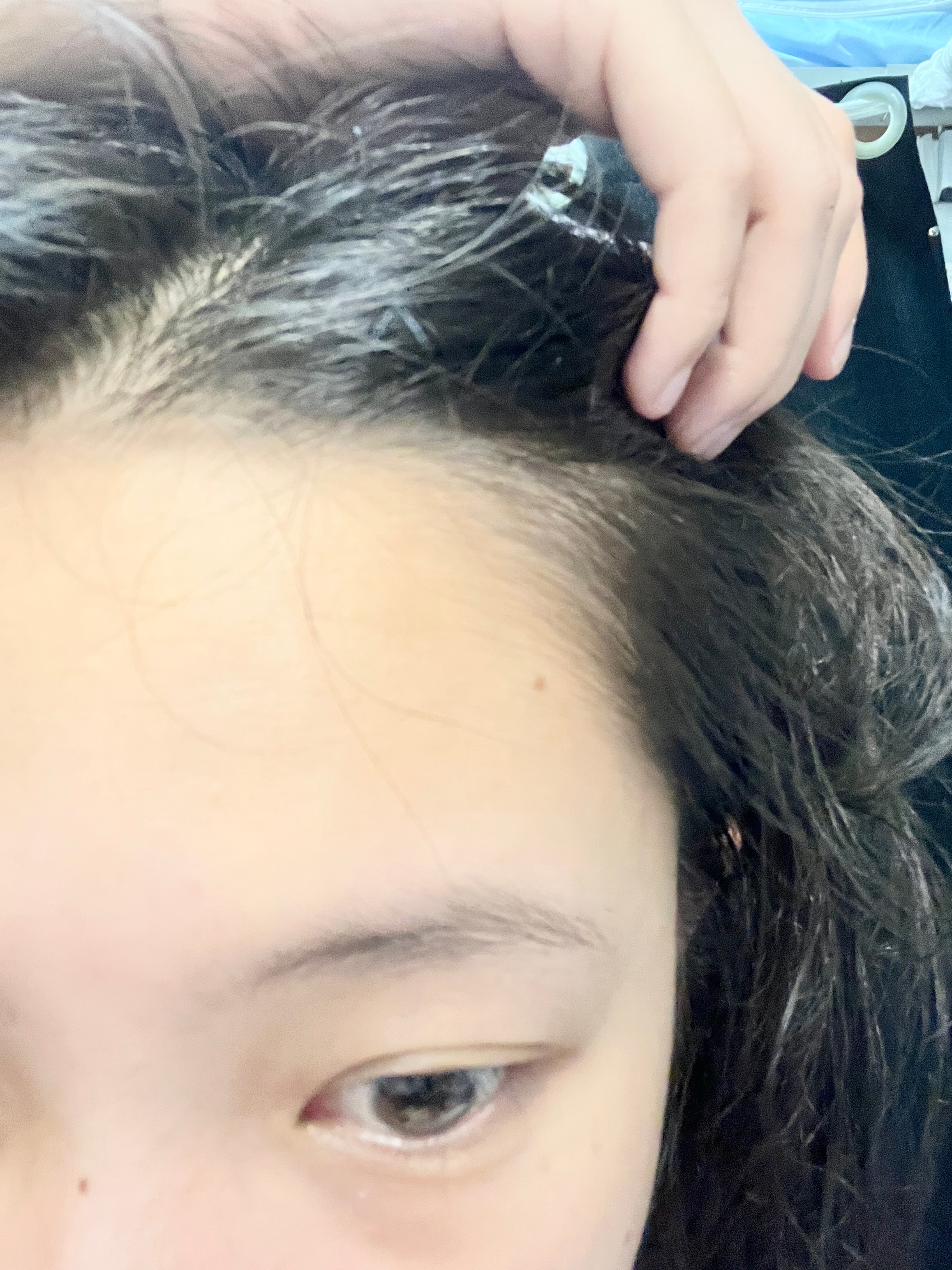 头发是尊嘟有在长多了一些...发际线处秃的都去用offrelax育发液！！这对比