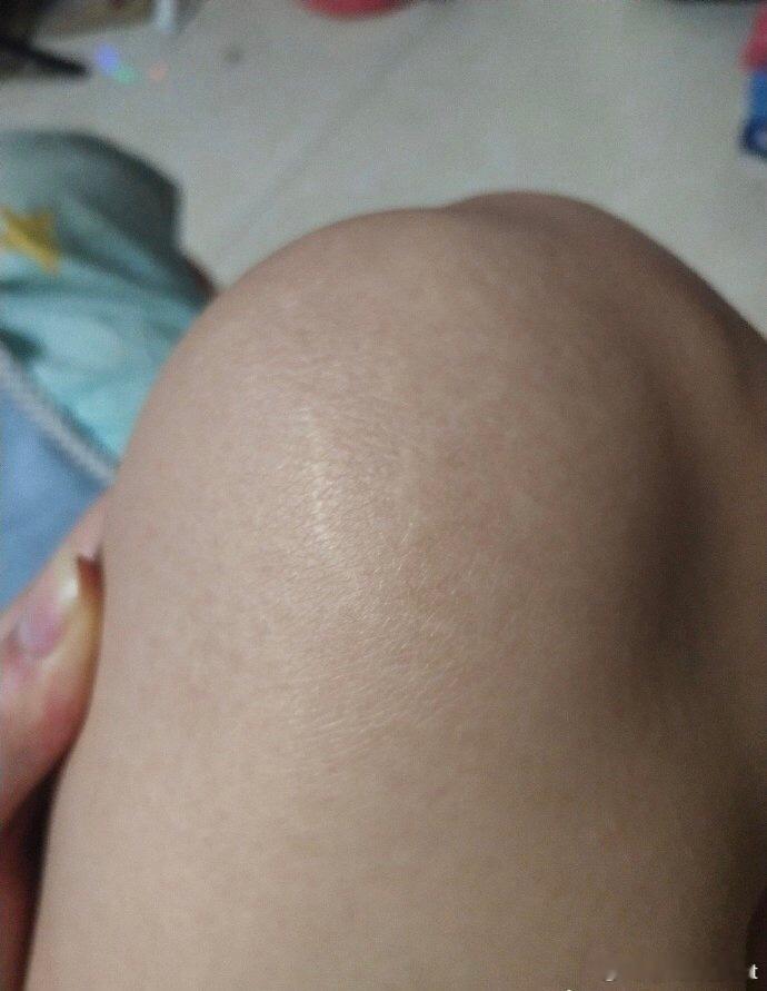网友投稿：我今天和女朋友分手了我没看到她腿上有妊娠纹她还是不承认她说那是脂肪痕迹