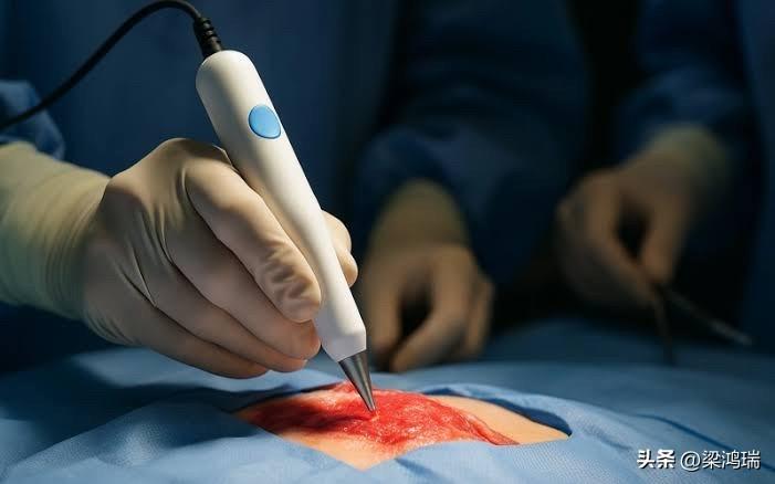 突发新闻：巴西科学家利维娅·埃伯林开发出一种笔，能够在医疗过程中仅需 10 秒即