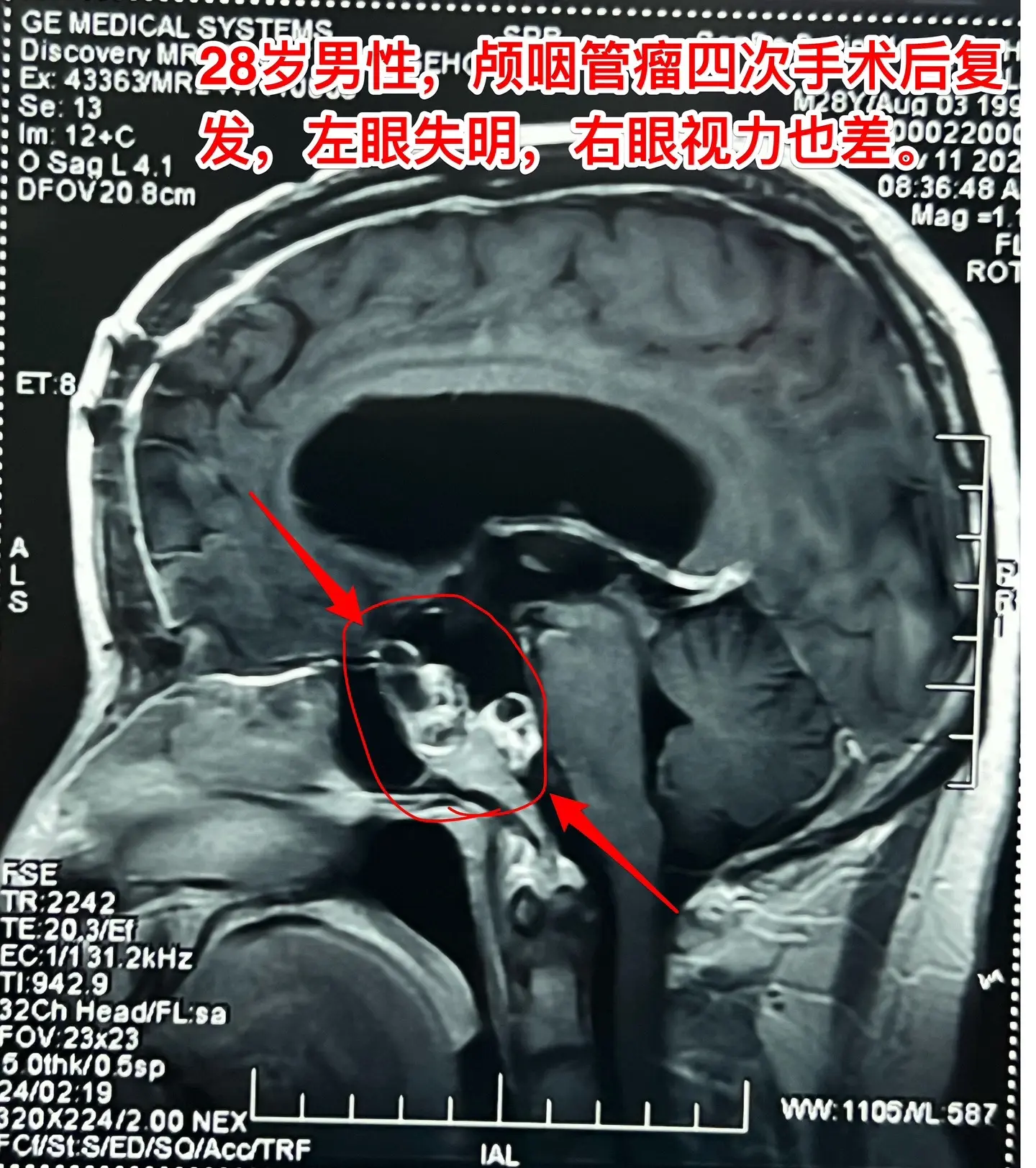 颅咽管瘤四次复发，为挽救视力只能作手术。28岁的四川小伙子，因颅咽管瘤...