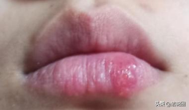 陕西一女子，嘴角长了小水泡后脑死亡！医生：这不是上火

那段时间，李倩总觉得自己