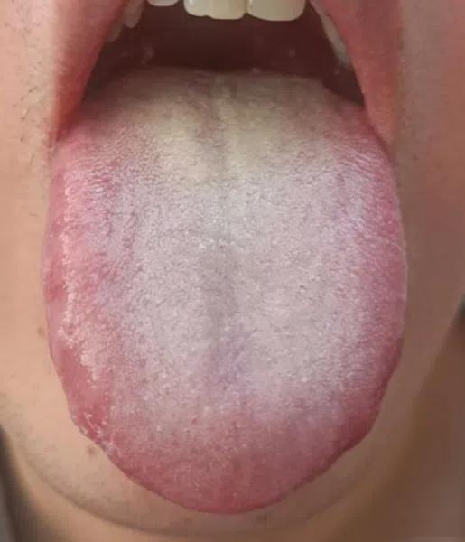 门诊上碰到一个很经典的舌象，赶紧发出来给大家看看，对照一下你是否也有类似问题？
