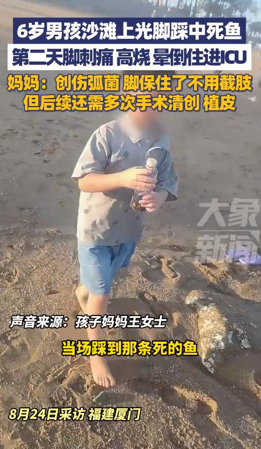 “防不胜防！”2025年8月，福建厦门，一名6岁男孩光脚在沙滩上玩，结果，第二天