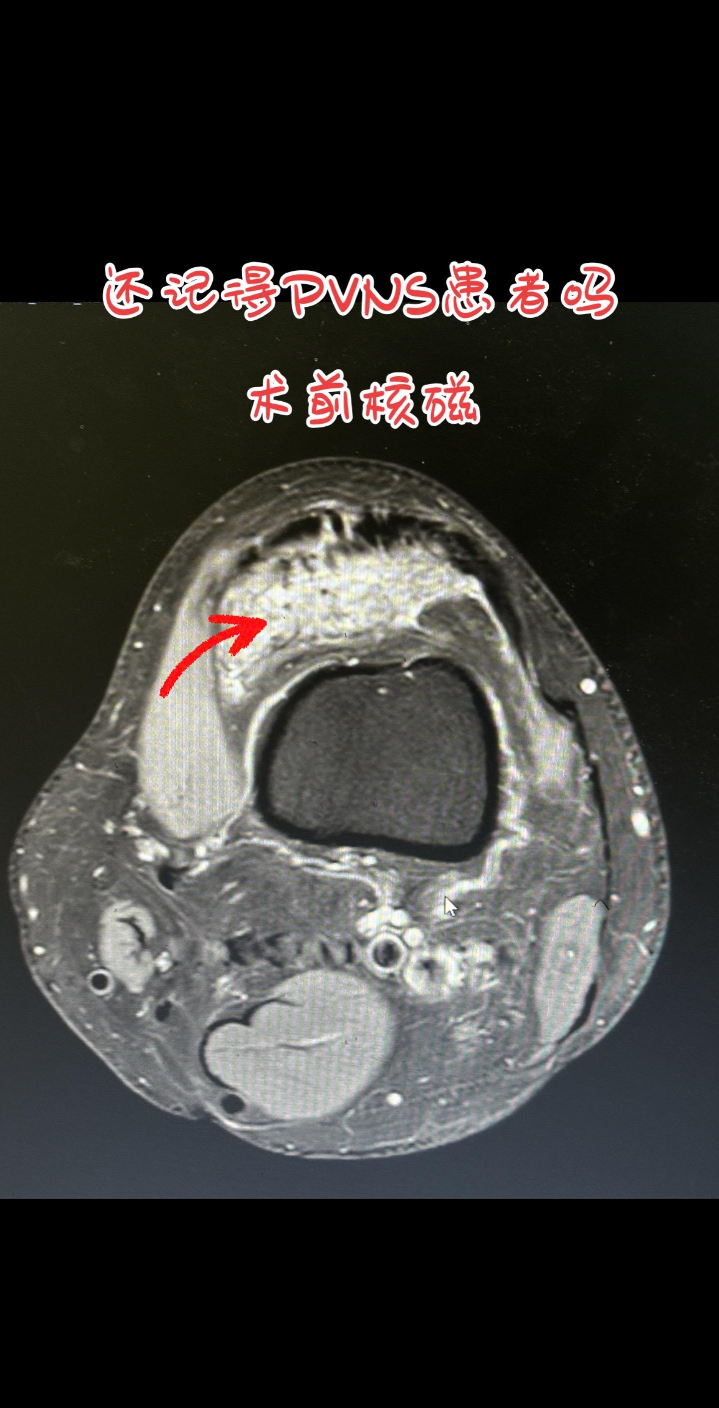 PVNS病灶关节镜切除术后怎么样。关节内的PVNS如果镜下都切不干净 ...