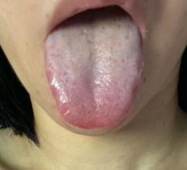 舌苔白腻泛黄，湿困脾胃，这种情况我不建议先健脾！
 
这是一位37岁的女患者，舌
