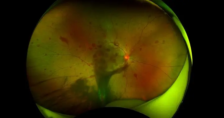 一阵剧烈咳嗽后右眼近乎失明 女子确诊这种眼病