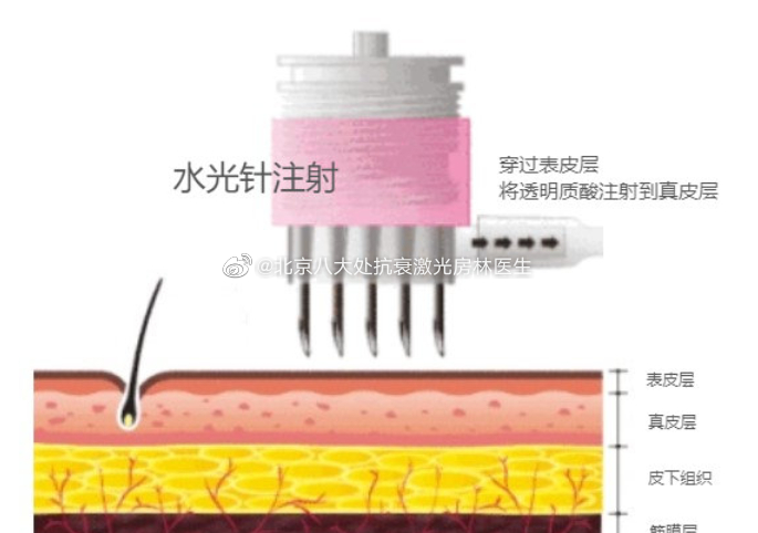 【水光针里的玻尿酸与注射玻尿酸一样吗？】#玻尿酸攻略详解##医美等于变美吗##微