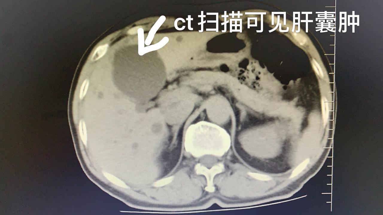 肝囊肿噌噌长，3个关键“祸因”没清除，看你属于哪一种？
 
长了肝囊肿的人，有的