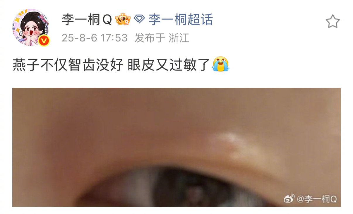 李一桐蜜蜂小狗预备役李一桐智齿没好眼皮又过敏了 近日，透露自己智齿没好眼皮又过敏