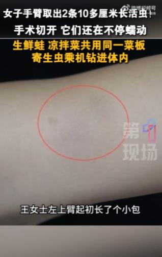 “太吓人了！”广东深圳，女子一年前手臂上长了个小包块，不痛不痒就没在意。谁知最近