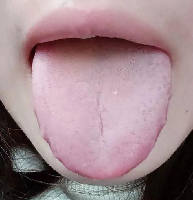 这个患者是一个容易上火的体质吗？
舌苔厚腻，舌尖格外发红，又是寒又是火的
整体外