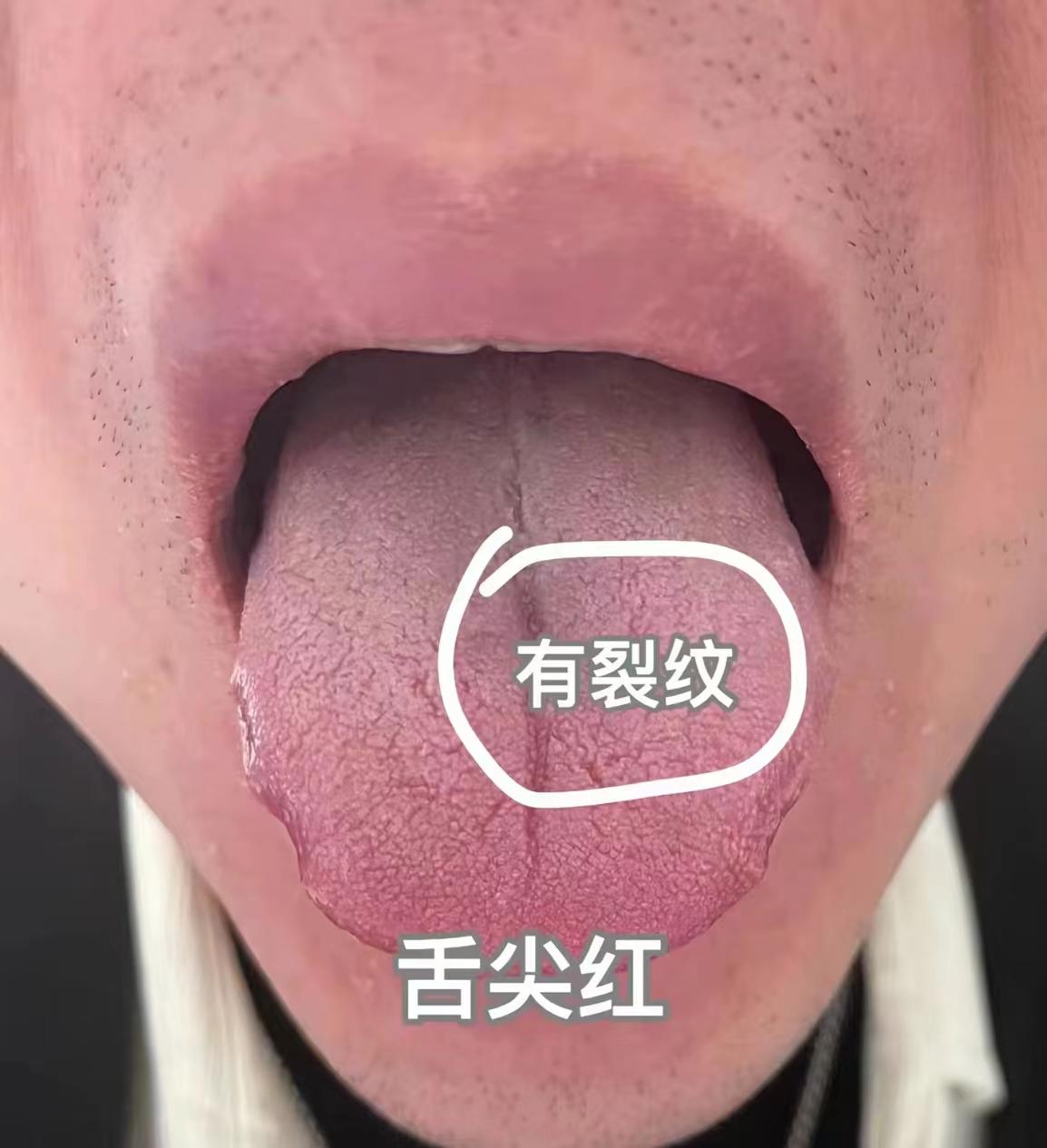 你不受罪谁受罪！这舌头你当成脾虚治？
今天遇到一位粉丝，舌头裂纹比较深，从舌尖裂