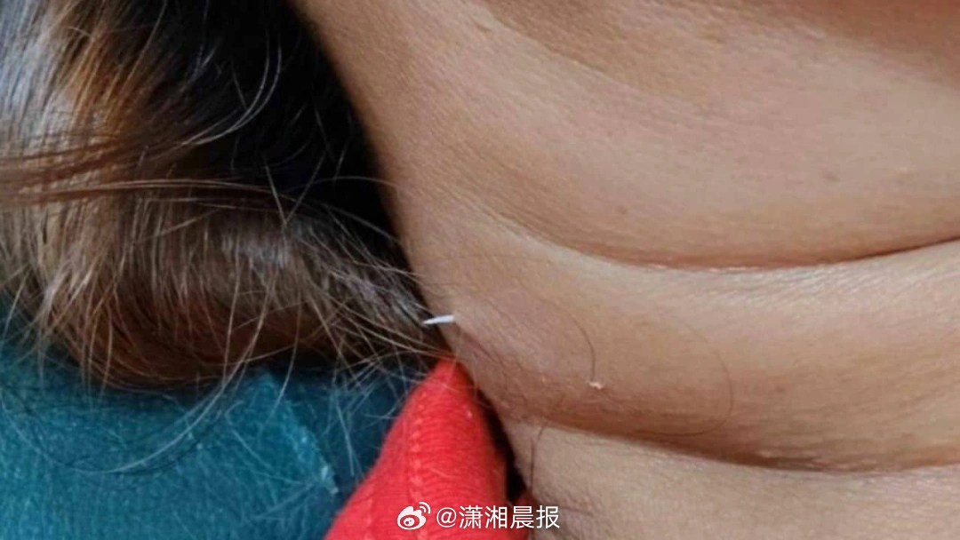 【泰国#女子吃鱼竟被鱼刺刺穿脖子##男子回应妻子吃鱼被鱼刺刺穿脖子#】17日，泰