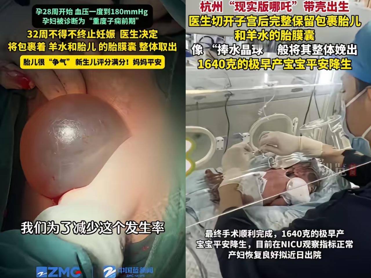 杭州这幕太震撼了！
32周的宝宝裹在“水晶球”里被取出来，
妥妥现实版“哪吒降世