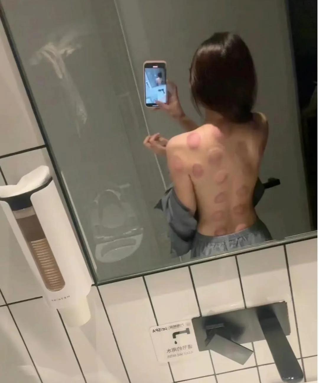 挺适合拔罐儿的！