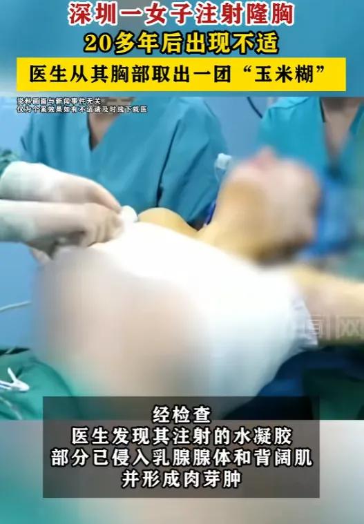 太吓人，6月25号，深圳王女士，因胸部持续不舒服去医院，发现当年打进去的透明凝胶