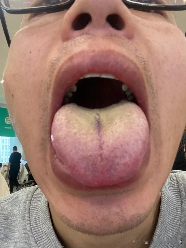 太夸张了，简直了，你这舌头是拖了多久了[what][what][what]
主诉