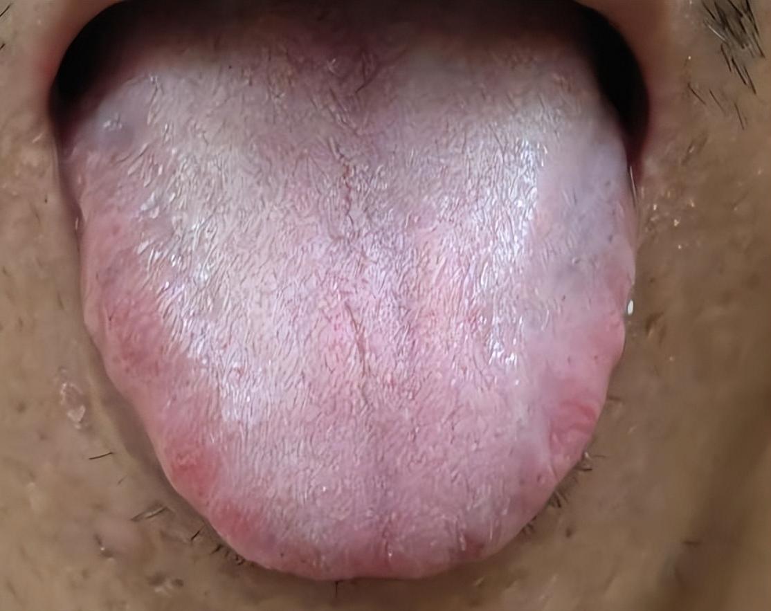 看这个舌象，尽管疏肝、健脾、补阳都用了，为什么仍没效果？

其实是因为体内有瘀，
