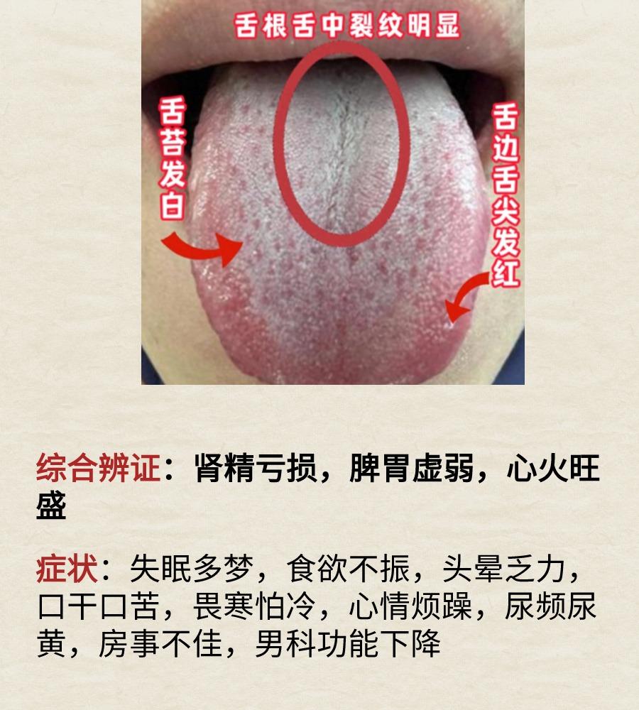 男科不行的三大典型舌象。