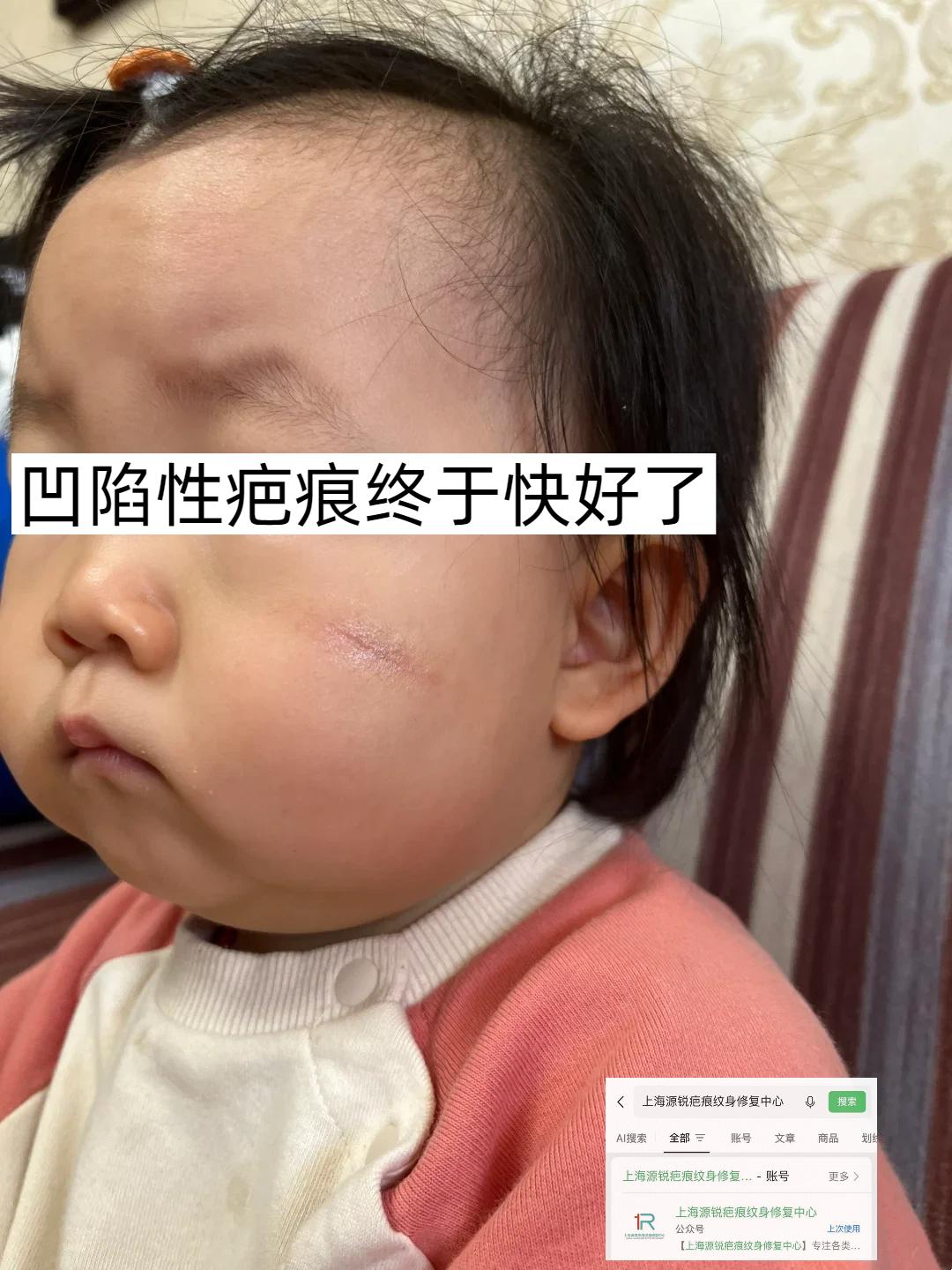 今年年初的时候，孩子脸上被我小手指指甲不小心划到，又细又长的印子，每次...