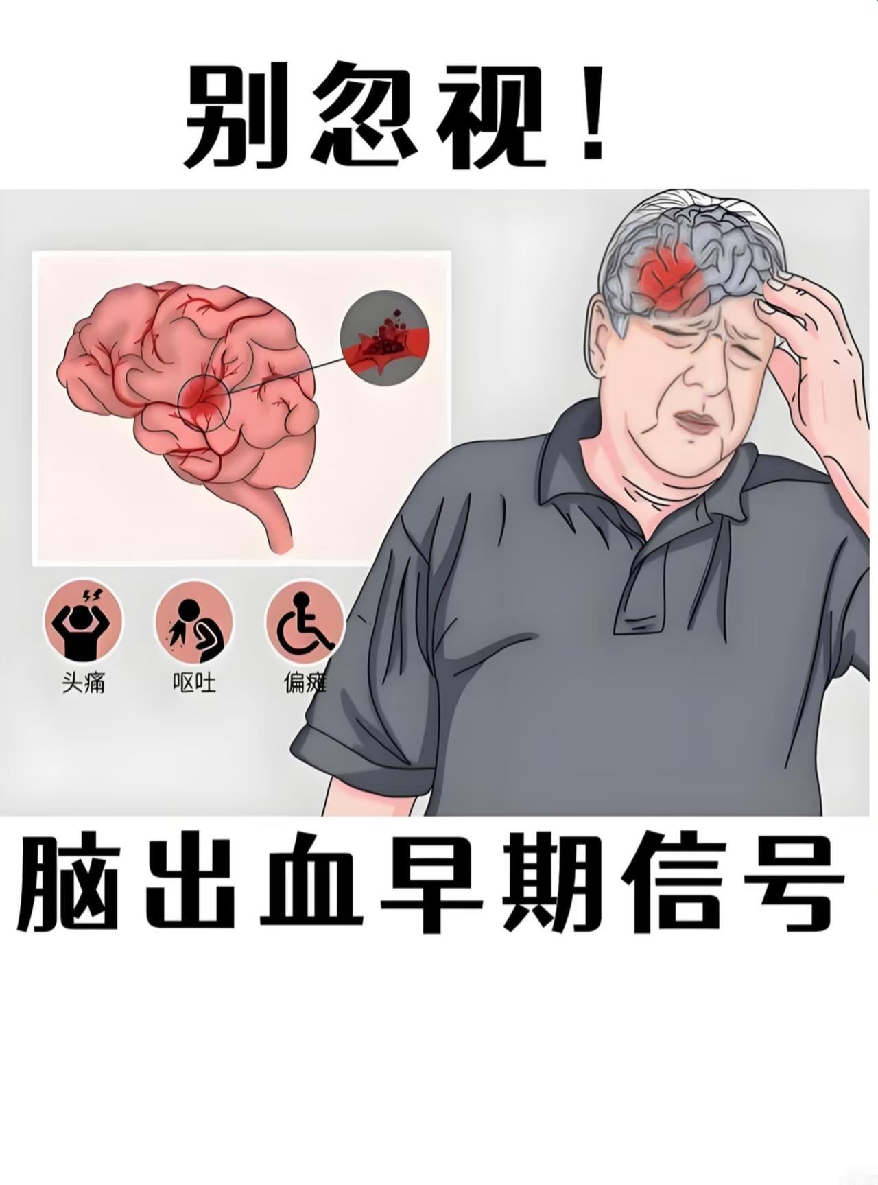 脑出血的前兆都有哪些?脑出血（俗称“脑溢血”）通常起病急骤，但很多患者在出血前数