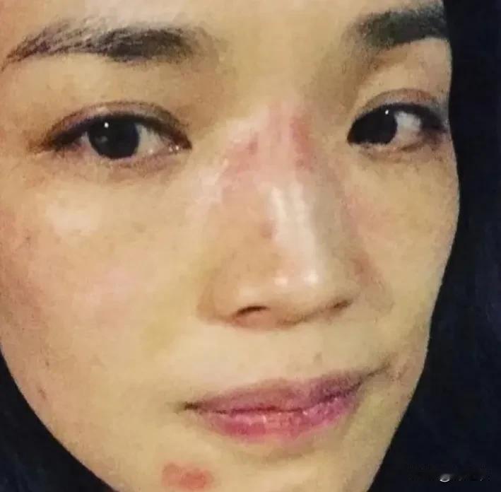 舒淇一个，还有吴建豪，这两个人经常过敏，这个应该就是免疫力低下的结果  ，要不然