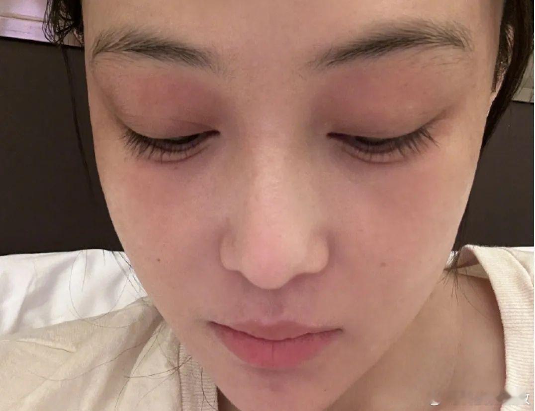 杨幂脸被蒸汽眼罩烫伤了杨幂用蒸汽眼罩居然被烫伤了！连明星都会中招，普通人还能大意