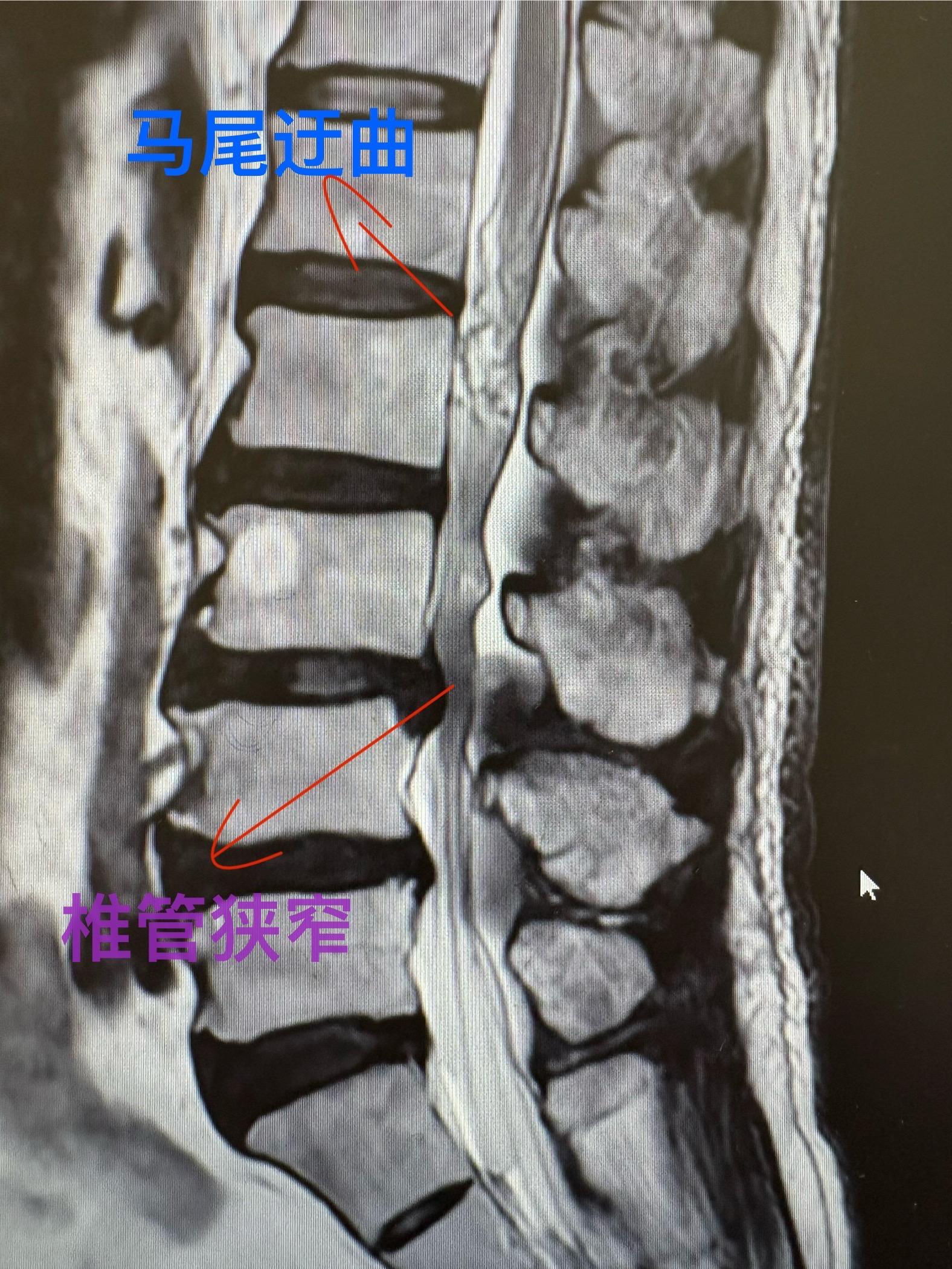 马尾迂曲。椎管狭窄造成的马尾迂曲，经常被误认为是肿瘤。椎管狭窄