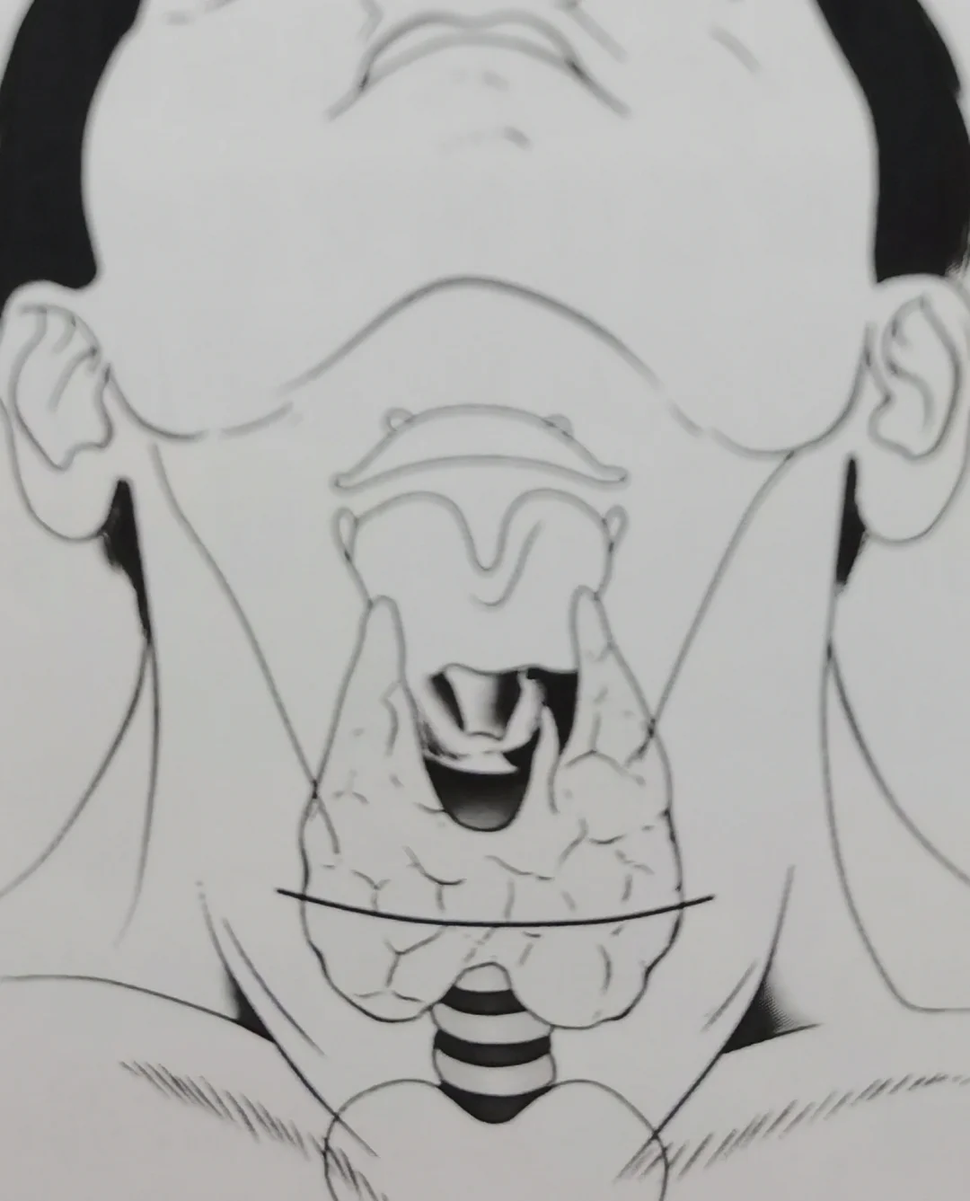 甲状腺结节，可能一半儿的人都有！