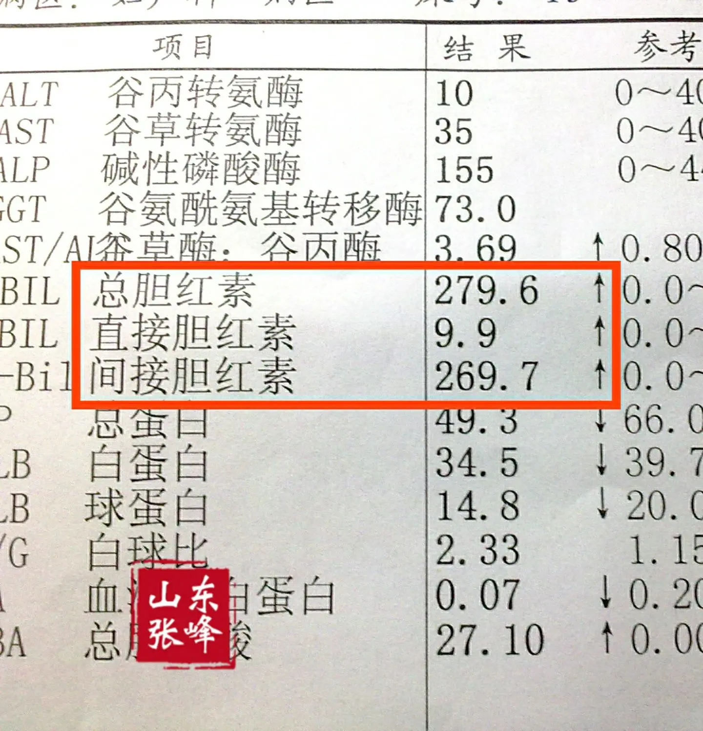 教大家如何正确认识胆红素的升高！ 胆红素分为总胆红素、直接胆红素、间接...