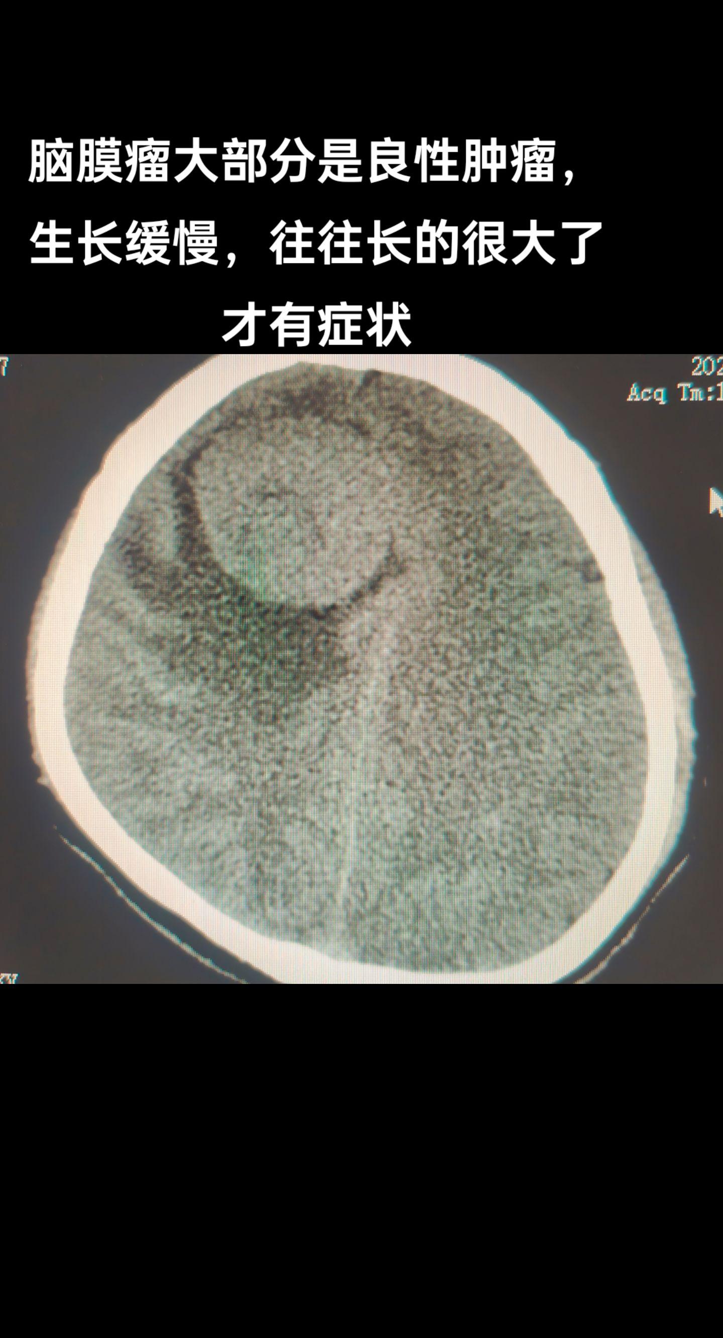 脑膜瘤大部分是良性肿瘤，生长缓慢