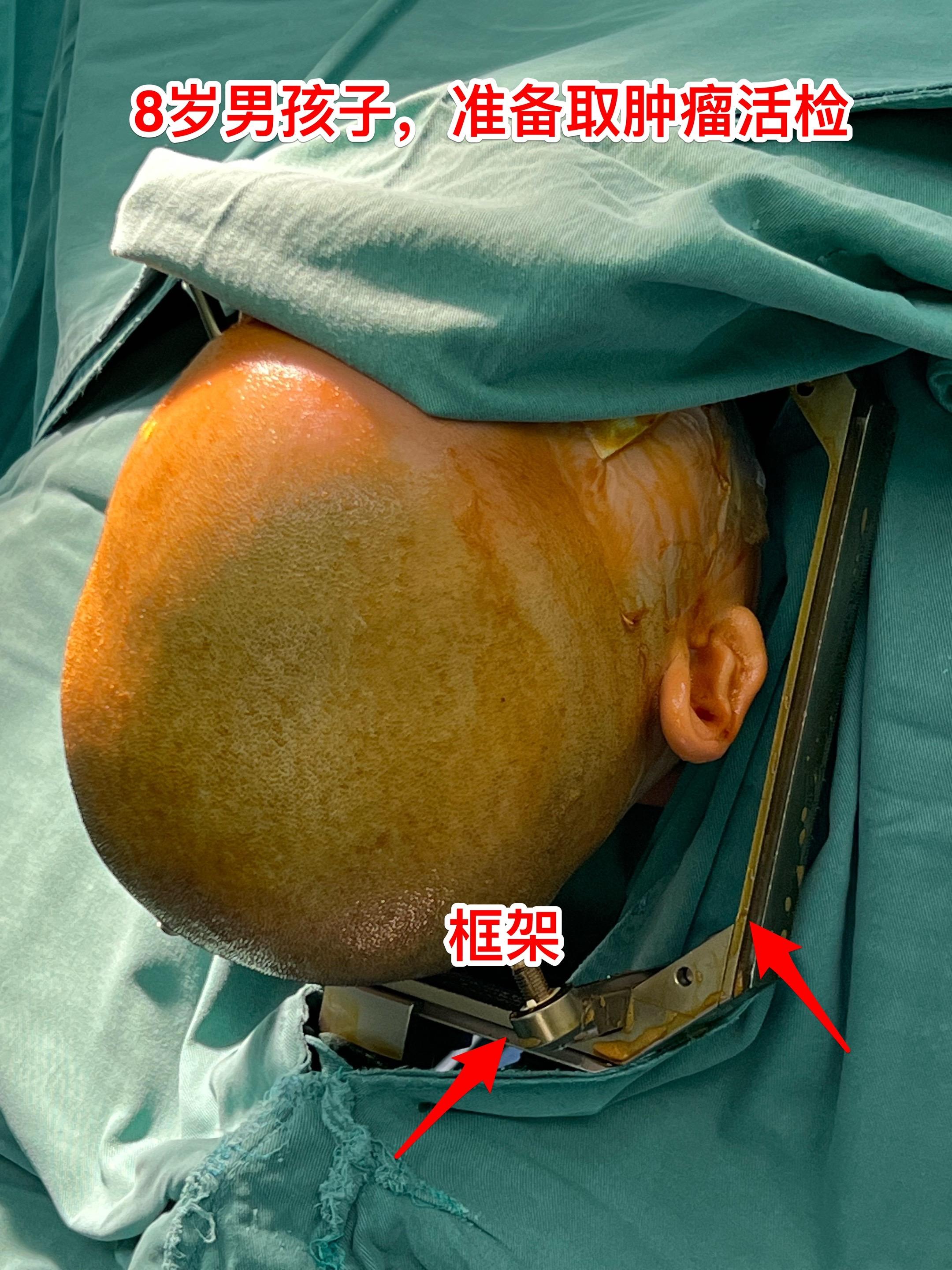 8岁男孩子性早熟，发现生殖细胞肿瘤。来自西安市的8岁男孩子，家长在一年...