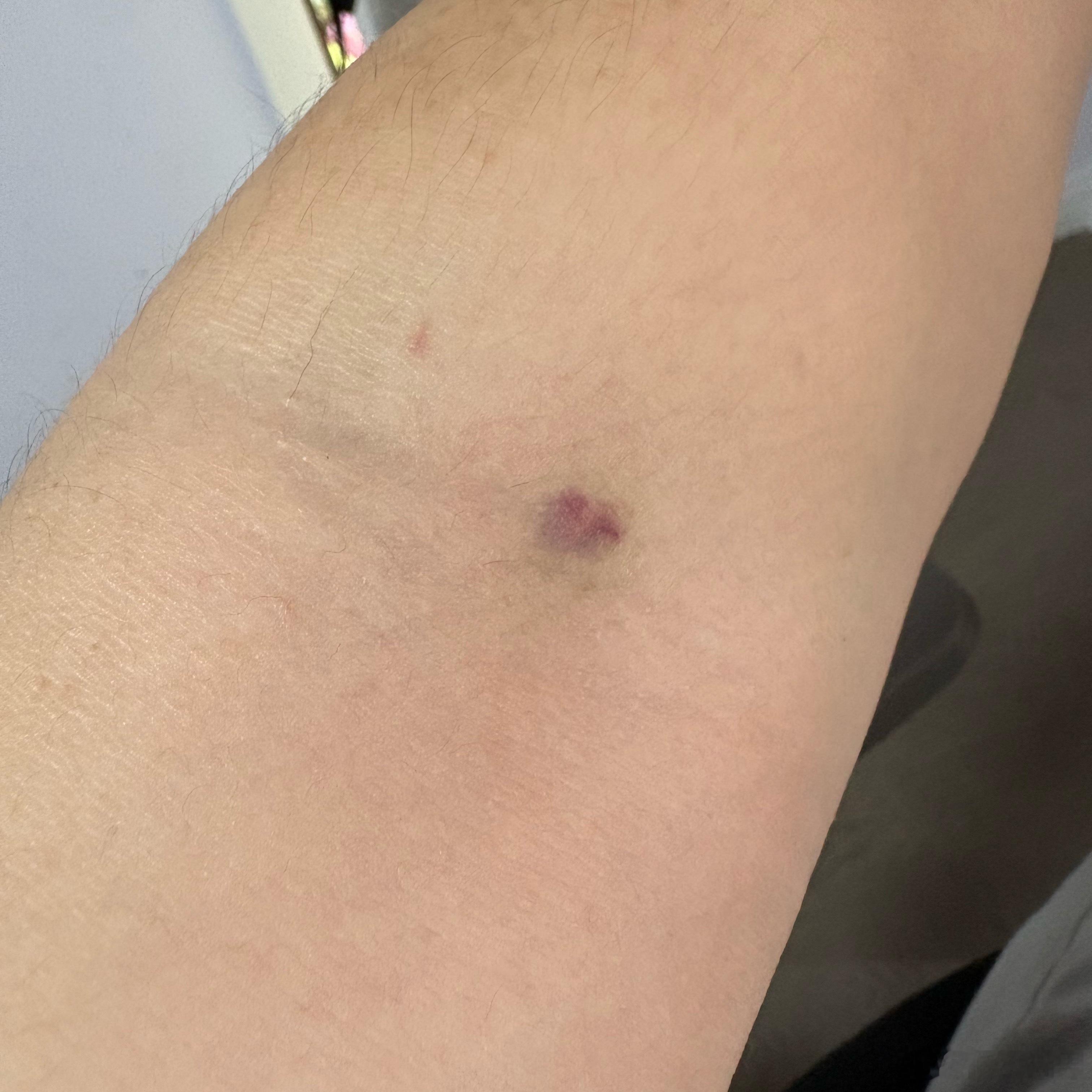 昨天去做糖耐测试被扎成这样 