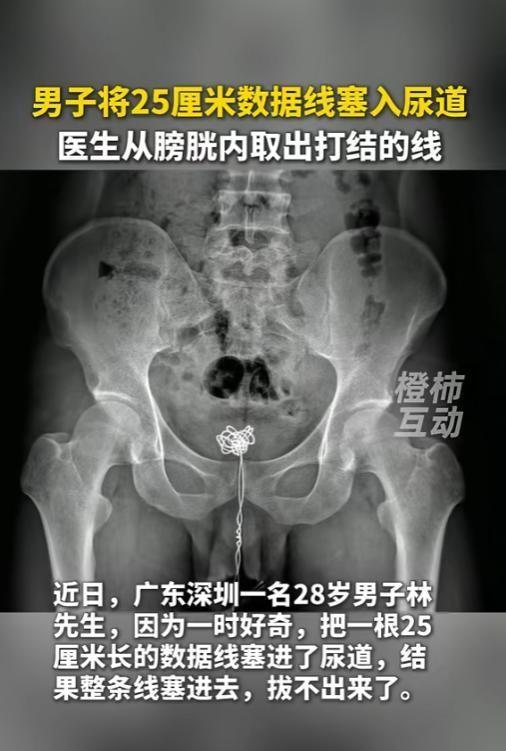 6月23日报道，广东深圳，一位28岁的成年男子，竟然因为好奇，把一根25厘米长的