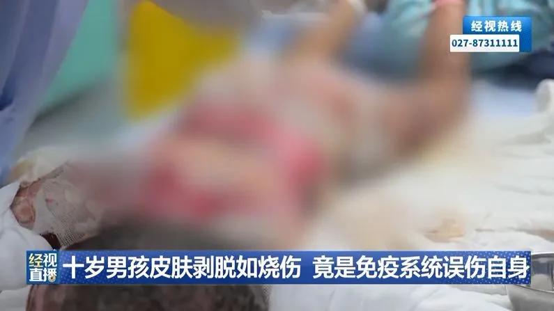 “太吓人了！”10月28日报道，湖北武汉，一男孩出现发烧眼红的症状，家人以为他受