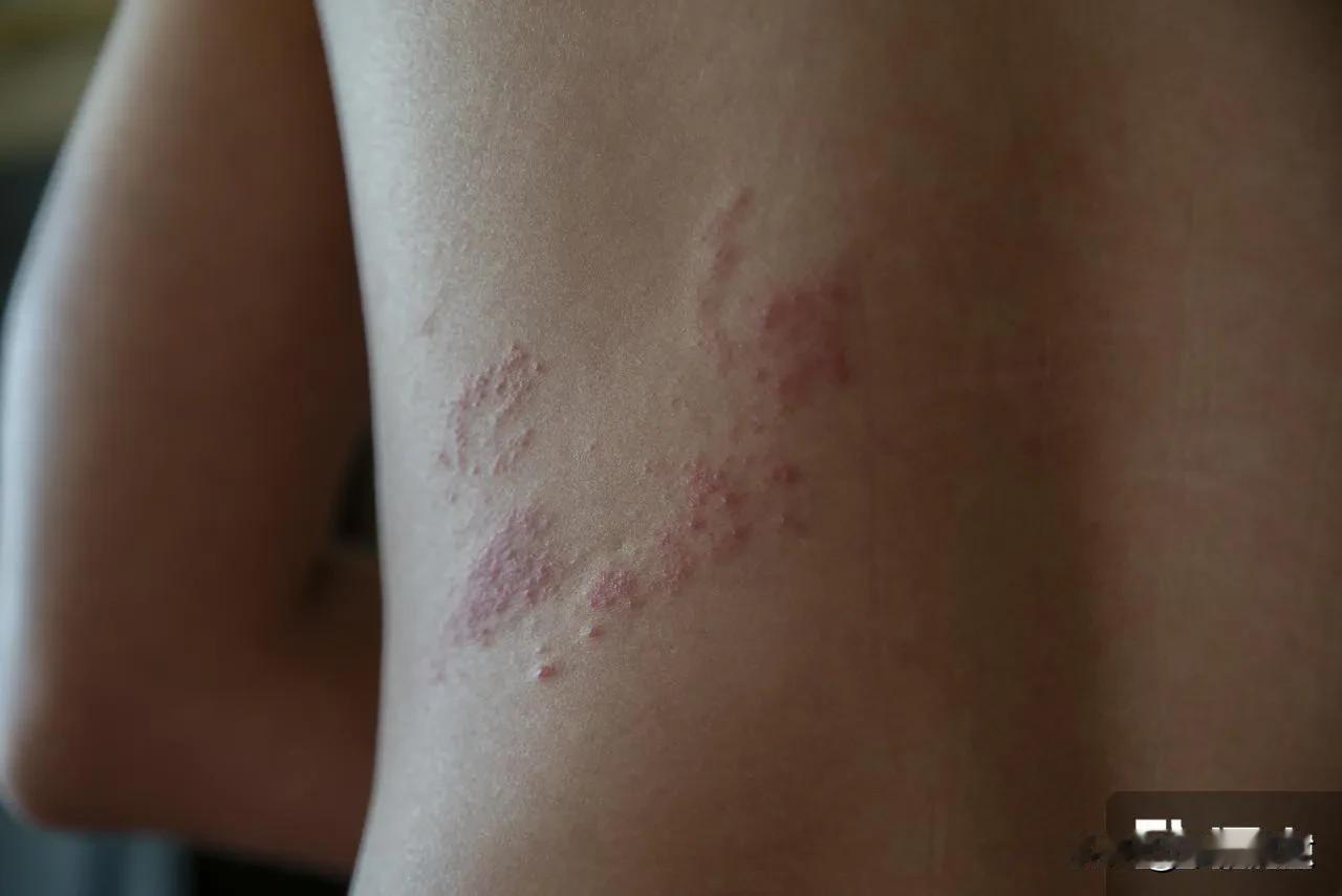 专家呼吁关注带状疱疹高风险人群，说起这个带状疱疹，我是深有体会呀

以前只听说蛇